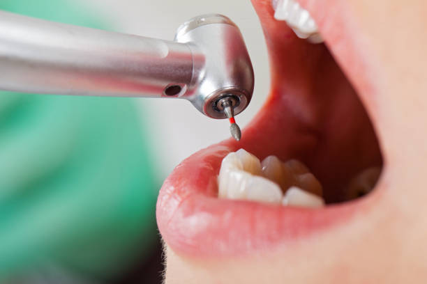 Best Dentist for Tooth Abscess  in Point Venture, TX